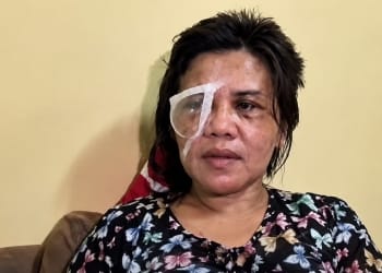 ART WNI korban penganiayaan majikan di Malaysia dengan kondisi mata terluka