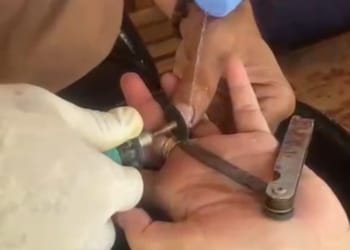 Petugas Damkar Jepara melepaskan cincin yang menjepit jari seorang wanita di Desa Slagi, Pakisaji, menggunakan mesin gerinda potong.